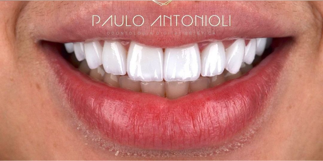 Tooth extraction aftercare: A how-to guide